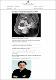 Rawatan fibroid tanpa pembedahan.pdf.jpg