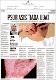 Psoriasis tiada ubat.pdf.jpg